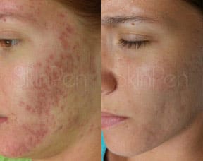 microneedling for acne scarring